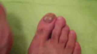 TOENAIL FUNGUS DOCUMENTARY DAY 1 [upl. by Pani736]