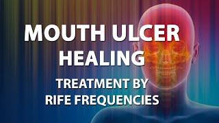 Mouth Ulcer Healing  RIFE Frequencies Treatment  Energy amp Quantum Medicine with Bioresonance [upl. by Eehc540]