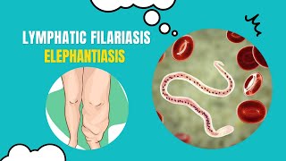 Unlocking the Secrets of Elephantiasis What You Need to Know [upl. by Nanete]