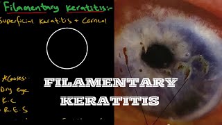 Filamentary Keratitis  Ophthalmology [upl. by Althea]