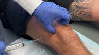 KNEE Intraarticular injection of Local Anaesthetic and Steroid [upl. by Narut837]