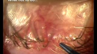 Demodex Blepharitis Is it for real [upl. by Bellamy]