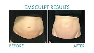 Emsculpt Burn Fat AND Build Muscle Without Exercise  Wisconsin Vein Center amp MediSpa [upl. by Nylarak]