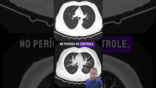 Tc de tórax para avaliação de nódulos pulmonares [upl. by Jeniece208]