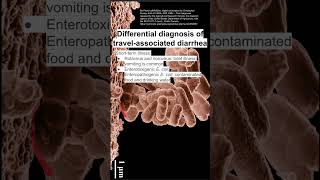 Differential diagnosis of travelassociated diarrhea [upl. by Acinomal640]