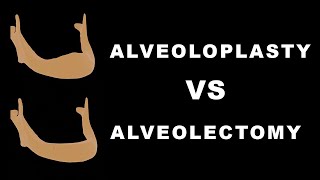 Alveoloplasty vs Alveolectomy [upl. by Valente]