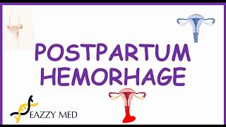 Postpartum Hemorrhage PPH causesrisk factorsprevention and treatment [upl. by Tneciv]