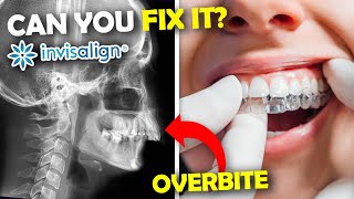 Extraction of teeth to correct overjetoverbite [upl. by Secunda591]