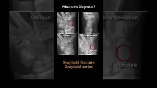 Scaphoid fracture  Scaphoid series 141Trauma Xray  Upper limb gallery 2radiologychannel007 [upl. by Ress545]