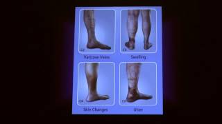 Treatment Options for Superficial Venous Disease  Cheryl Hoffman MD  UCLA Health [upl. by Reamy]