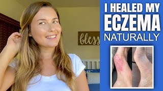 How I Healed My Eczema amp Psoriases Naturally [upl. by Quinta]