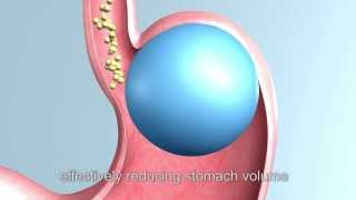 gastric balloon gastric balloon weight loss intragastric balloon  Bariatric Surgery hong kong [upl. by Jessamine]