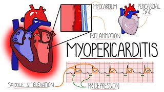 Myocarditis amp Pericarditis Myopericarditis Explained [upl. by Yurt]