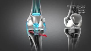 Tibial Valgus Osteotomy [upl. by Ader]