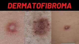 Dermatofibroma Causes Symptoms What is it How is it treated Benign Fibrous Histiocytoma [upl. by Anirba934]