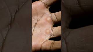 Corns amp calluses Urdu short video [upl. by Livvyy]