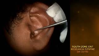 IMPACTED EAR WAX REMOVAL WITH HOOK HD [upl. by Summons]