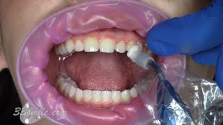 Prepless noninvasive porcelain veneers Cosmetic dentistry procedural video with results [upl. by Enowtna]