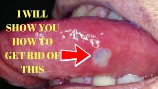 how to get rid of canker sores on tongue canker sores in mouth treatment [upl. by Edana]