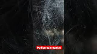 Pediculosis extreme  very severe head lice infestation shorts [upl. by Retsub265]