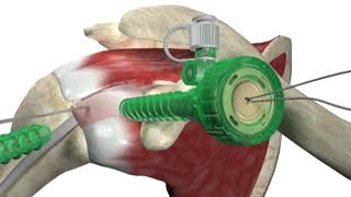 Biceptor Tenodesis System  Surgical Technique Walkthrough  SIMON MOYES [upl. by Eybbob402]