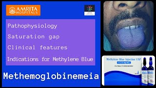 Methemoglobinemeia  Saturation gap  Methylene blue [upl. by Lorain]