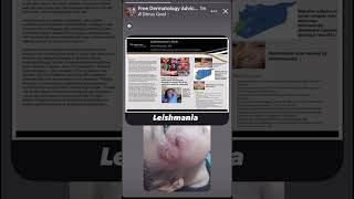 Leishmania free skincare drmanalabokwidir3098 [upl. by Ettenot]