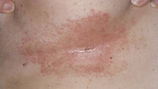 DermTV  How to Treat Under Breast Rashes amp Infections DermTVcom Epi 190 [upl. by Sirrom]