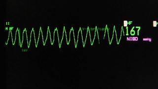 ventricular tachycardia  Torsade de Pointes on an ECG heart monitor [upl. by Prichard]