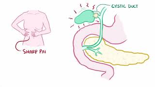 Biliary colic gallbladder attack causes symptoms diagnosis treatment amp pathology [upl. by Poock]