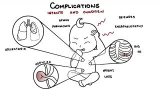 What is Pertussis and whooping cough  Bordetella pertussis symptoms pathophysiology and treatment [upl. by Esserac]