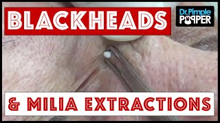 Whiteheads amp Milia with Dr Pimple Popper [upl. by Ahsinnod]