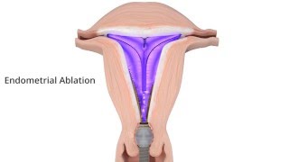 Minervas Three Principles of Ablation [upl. by Ailet]