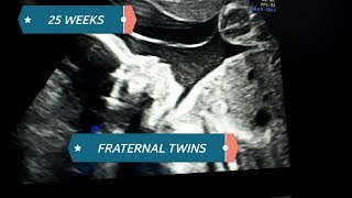 Fraternal twins 25 weeks ultrasound part 1😉😉😉 [upl. by Kort]