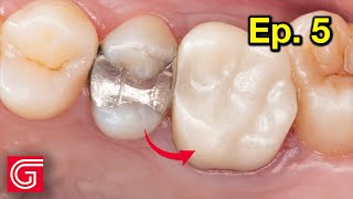 HOW TO Cement FULLY Sintered Zirconia Crown INOffice  Ep 5 [upl. by Kcirddot434]