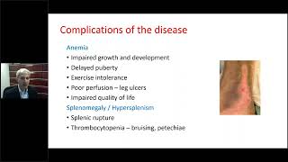 Complications of Thalassemia Disease Effects and Treatment Effects [upl. by Richey925]