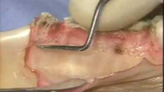 Introductory Periodontal Surgical Techniques The Apically Positioned Flap and Crown Lengthening [upl. by Tarazi]