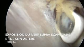 libération Nerf supra scapulaire arthroscopie épaule HD  Dr Thomas Waitzenegger [upl. by Ahsap]