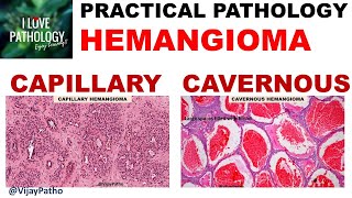 HEMANGIOMA capillary amp Cavernous Clinical features amp Morphology [upl. by Shuma]