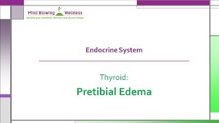 Pretibial EdemaThyroid [upl. by Truda]