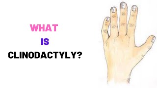 WHAT IS CLINODACTYLY Clinodactyly Causes Symptoms Treatment Surgery [upl. by Aihsyn]