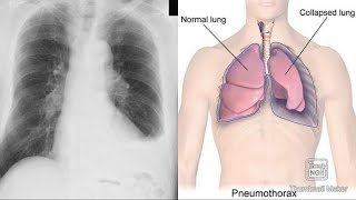 Pleurisy Pleural effusion Pneumothorax Hydropneumothorax Empyema Hemothorax clinicalAnatomy [upl. by Ebaj441]