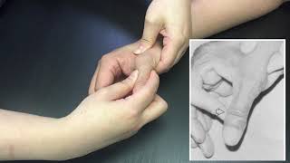 Special test  Thumb Ulnar Collateral Ligament Instability test [upl. by Yhtomit246]