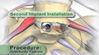 Medical Animation Lumbar Interbody Fusionflv [upl. by Oirifrop]