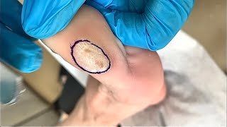 Callus removal from feetampFoot scraping dead skin【Xiao Yan pedicure】stress 117 [upl. by Darbee]