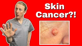 Squamous Cell Skin Cancer SCC  What You Need to Know for Early Detection and Treatment [upl. by Iago980]