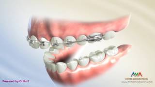 Orthodontic Treatment for Overjet Overbite  Forsus Appliance [upl. by Nodaj]