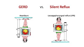 GERD heartburn vs Silent Reflux No difference in treatment Why [upl. by Ahcsim]