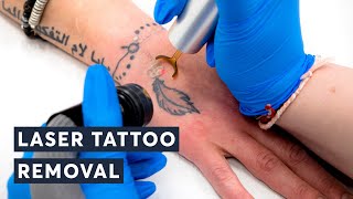 Fast Facts How Long Does Laser Tattoo Removal Really Take [upl. by Ennaeirrac536]