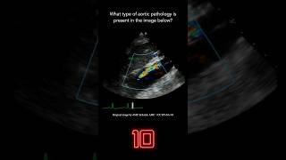 Echocardiography Question 9 [upl. by Jangro]